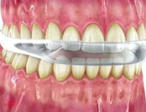 Tratamento de Bruxismo e apertamento dentário