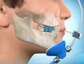 Ortopedia mecânica e funcional da face e maxilares